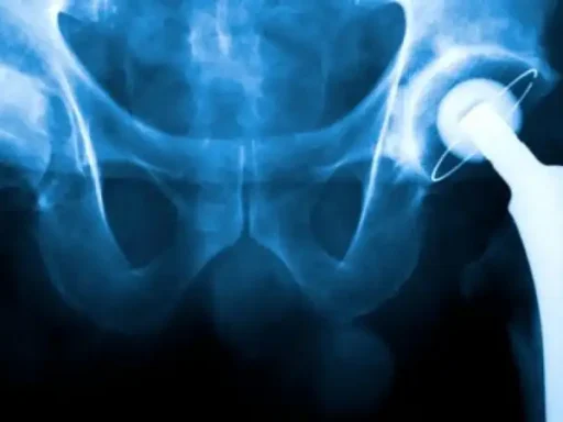 What Are The Disadvantages Of Robotic Hip Replacement?