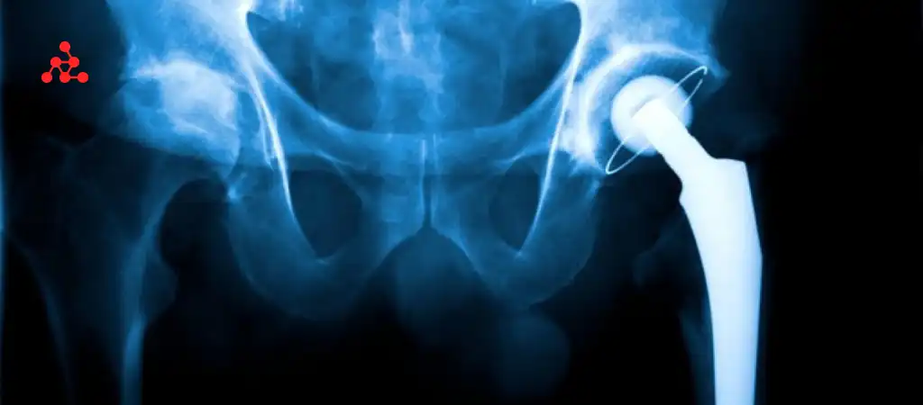 What Are The Disadvantages Of Robotic Hip Replacement?